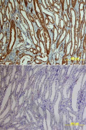 beta-Catenin antibody in Human Kidney Cancer Tissue by Immunohistochemistry (IHC-P).