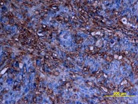 cIAP-2/HIAP-1 antibody in Human Colon Cancer Tissue by Immunohistochemistry (IHC-P).