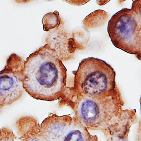 gp96/HSP90B1 antibody in Human Mesothelioma Tissue by Immunohistochemistry (IHC-P).