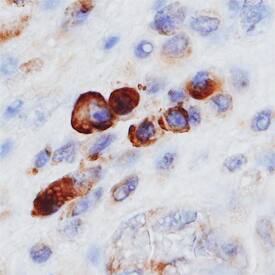 gp96/HSP90B1 antibody in Human Mesothelioma by Immunohistochemistry (IHC-P).