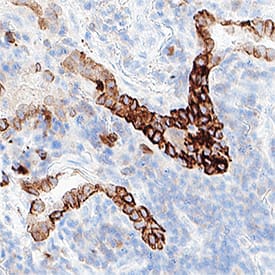 Detection of Cytokeratin 7 in Human Lung Cancer.