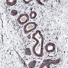 Akt Pan Specific antibody in Human Breast Cancer Tissue by Immunohistochemistry (IHC-P).