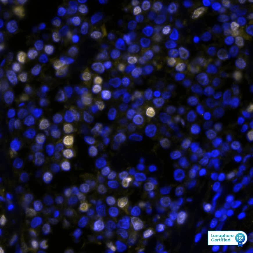 IRF4 Antibody (MUM1/8274R) IRF4 in Human Hodgkin’s Lymphoma via seqIF™ staining on COMET™