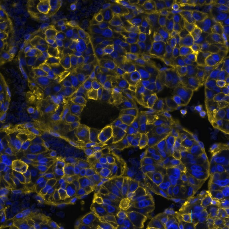 HLA ABC Antibody (MHC-I/8366R) - Azide and BSA Free HLA ABC Antibody (MHC-I/8366R) Detection of HLA-ABC/MHC I in Human Liver Tumor via seqIF� staining on COMET�