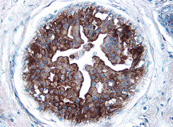 p21/CIP1/CDKN1A antibody in Human Breast Cancer Tissue by Immunohistochemistry (IHC-P).
