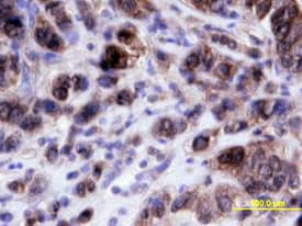 p21/CIP1/CDKN1A antibody in Human Breast Cancer Tissue by Immunohistochemistry (IHC-P).