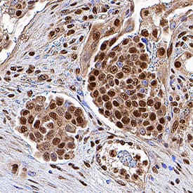 p300 antibody in Human Colon Cancer Tissue by Immunohistochemistry (IHC-P).