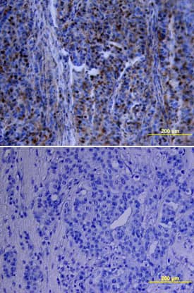 p70 S6 Kinase antibody in Human Breast Cancer Tissue by Immunohistochemistry (IHC-P).