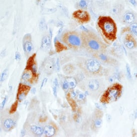 pIgR antibody in Human Liver Cancer Tissue by Immunohistochemistry (IHC-P).