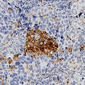 uPAR antibody in Human Lung Cancer Tissue by Immunohistochemistry (IHC-P).