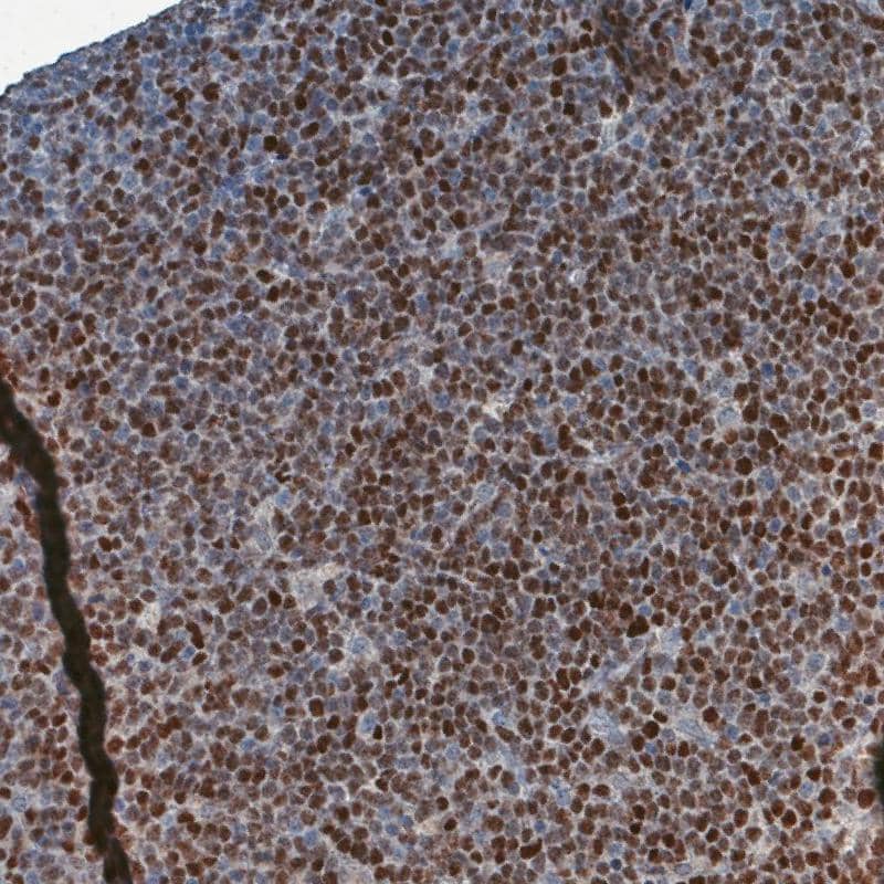 SOX11 Antibody (CL0142) - BSA Free Immunohistochemistry: SOX11 Antibody (CL0142) [NBP3-52441]