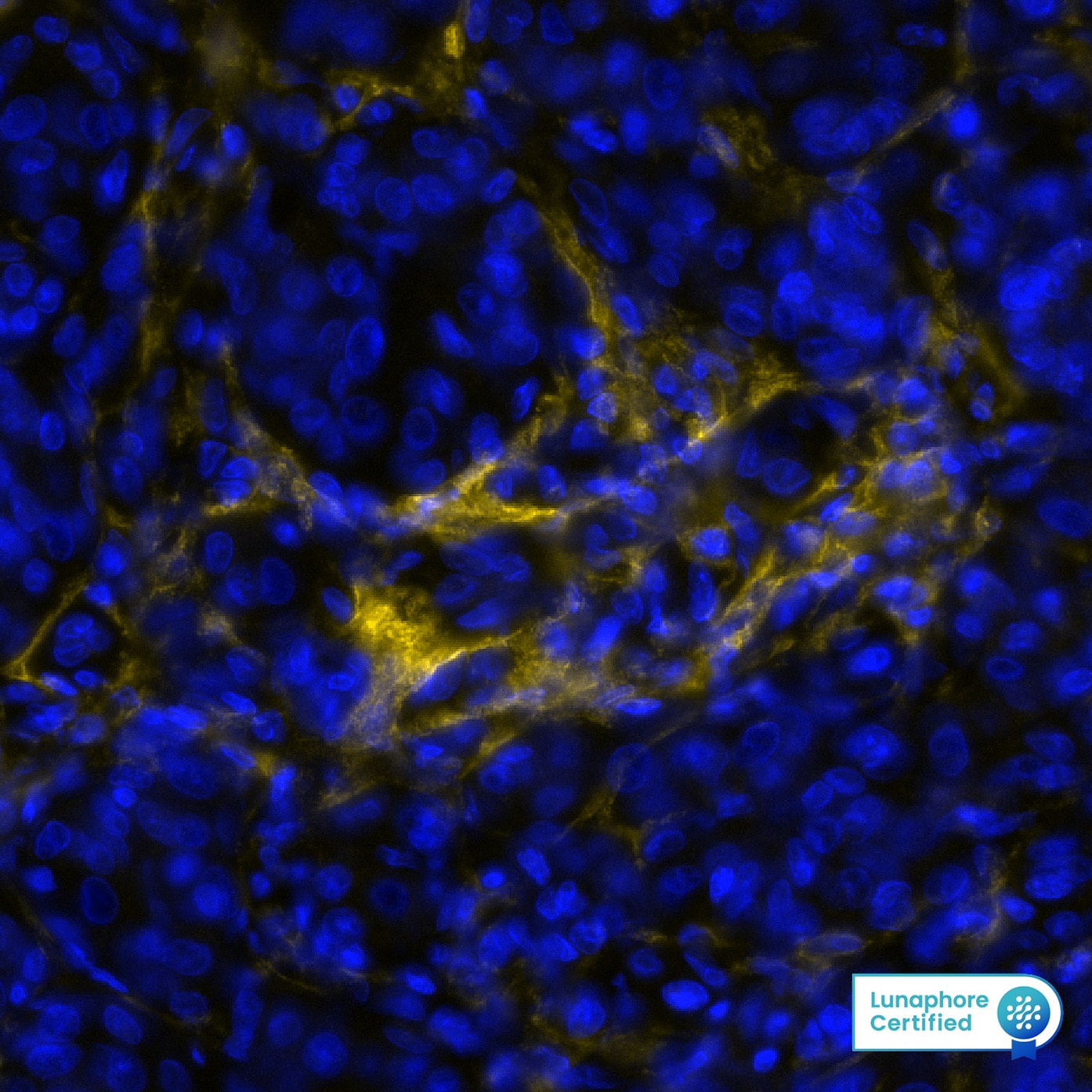 Fibroblast Activation Protein alpha/FAP Antibody (BLR150J) Detection of FAP in Human Melanoma via seqIF™ staining on COMET™
