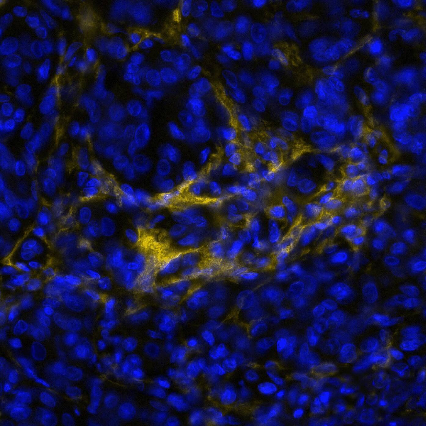 Fibroblast Activation Protein alpha/FAP Antibody (BLR150J) Detection of FAP in Human Melanoma via seqIF™ staining on COMET™