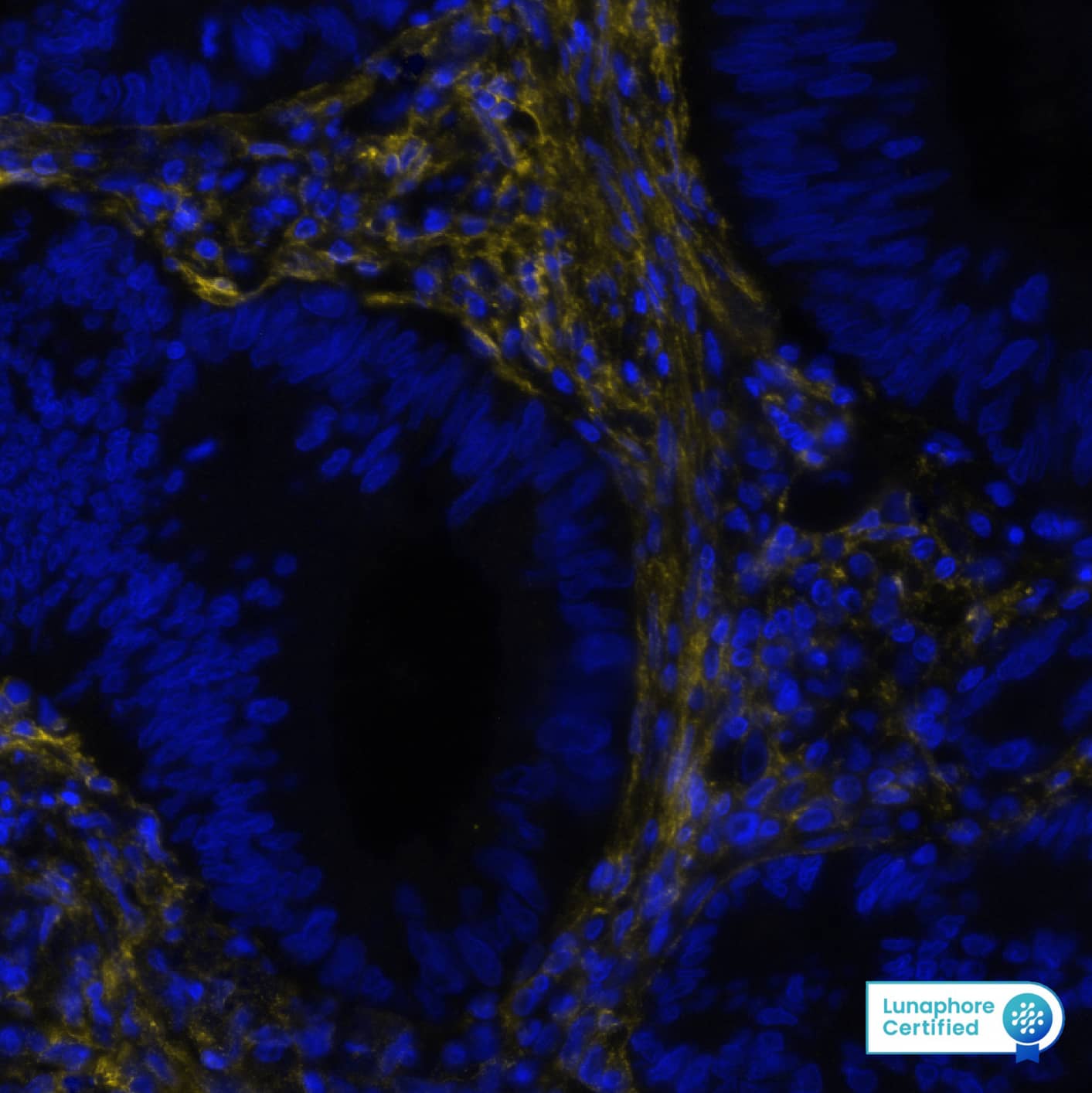 Fibroblast Activation Protein alpha/FAP Antibody (BLR150J) Detection of FAP in Human Colon Cancer via seqIF™ staining on COMET™