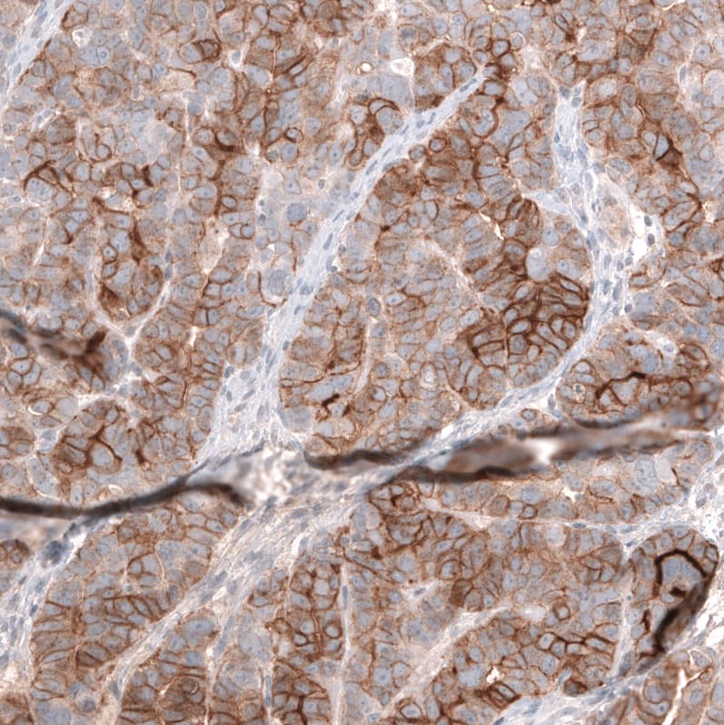 Mesothelin Antibody (CL13956) - Azide and BSA Free Immunohistochemistry-Paraffin: Mesothelin Antibody [NBP3-43845]