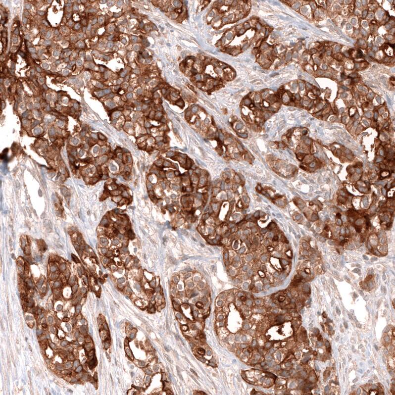 Mesothelin Antibody (CL13957) - Azide and BSA Free Immunohistochemistry-Paraffin: Mesothelin Antibody [NBP3-43846]