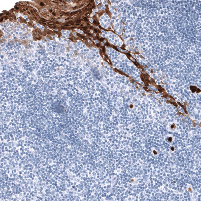 S100A9 Antibody (CL11191) - Azide and BSA Free Immunohistochemistry-Paraffin: S100A9 Antibody [NBP3-43896]