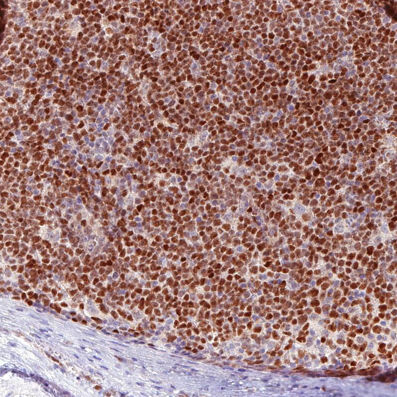 SOX11 Antibody (CL0143) Immunohistochemistry: SOX11 Antibody (CL0143) [NBP3-52090]
