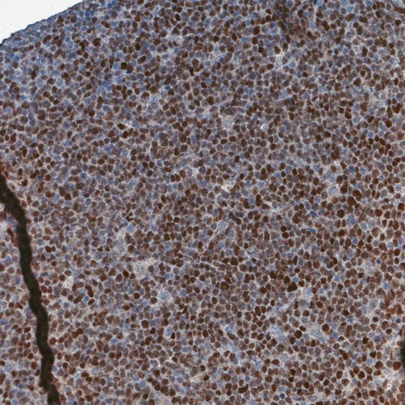 SOX11 Antibody (CL0142) Immunohistochemistry-Paraffin: SOX11 Antibody (CL0143) [NBP3-52442]