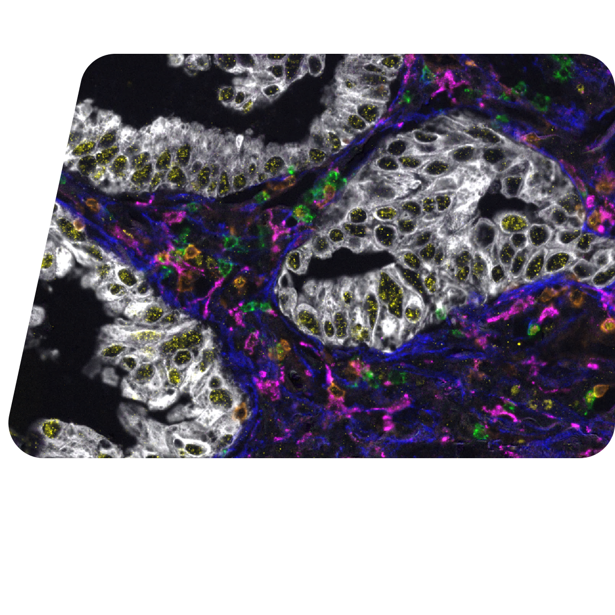 Spatial biology fluorescence microscopy image of human lung cancer tissue with multicolored cellular staining.